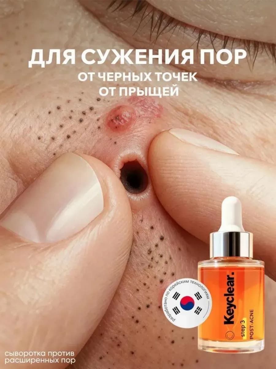 Сыворотка для лица от прыщей и акне