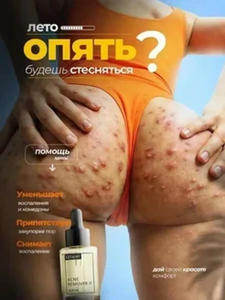 Сыворотка для лица от прыщей с салициловой кислотой