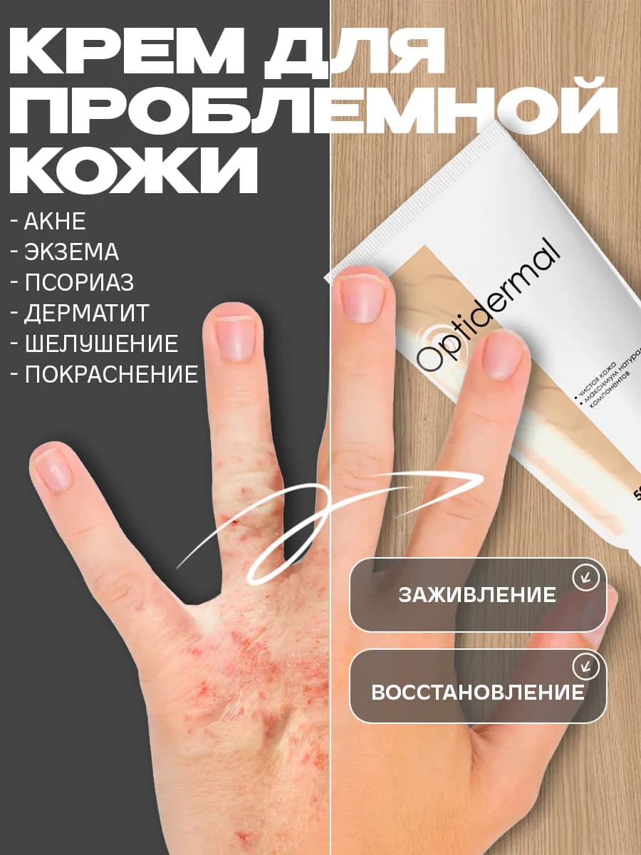 Мазь от псориаза от прыщей и дерматита