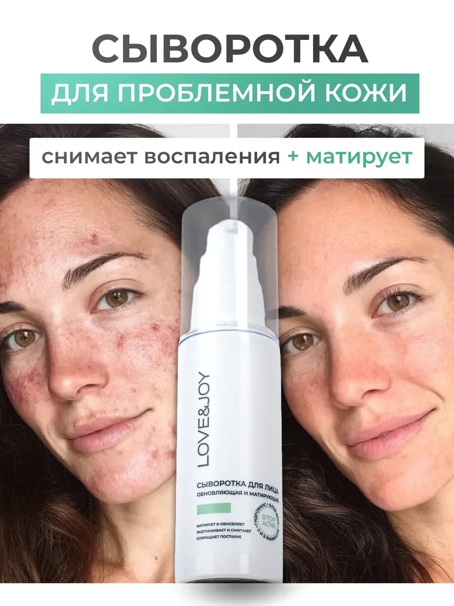 Сыворотка для лица от прыщей - фото 1