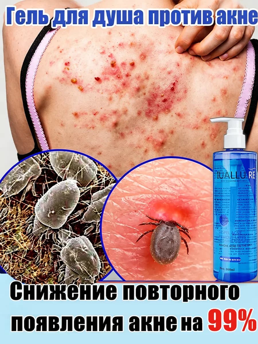 Гель для душа и умывания очищающий от прыщей гипоаллергенный