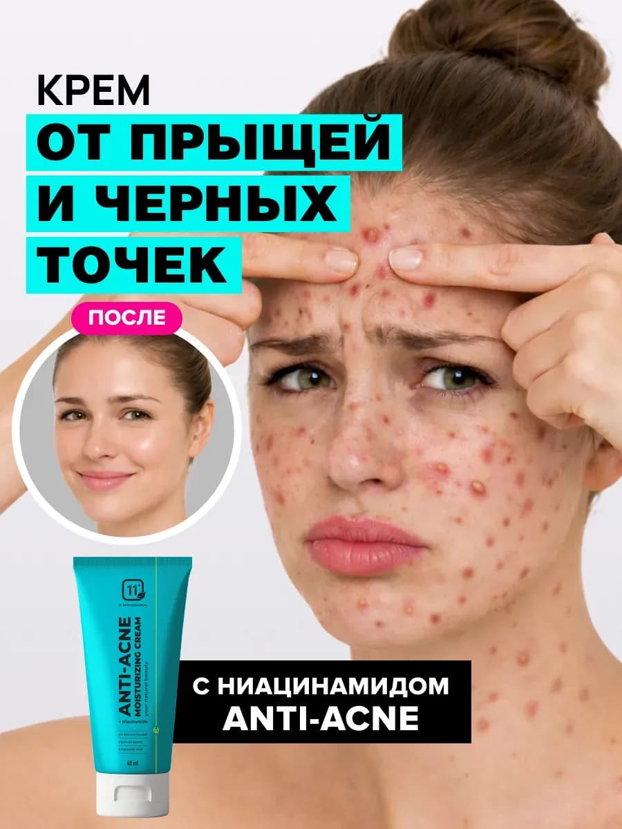 Крем от прыщей на лице. От черных точек с ниацинамидом